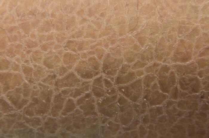 皮肤干燥、脱屑以及鱼鳞状的皮损